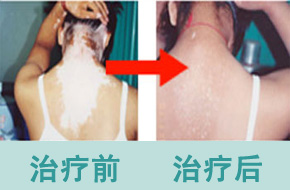 如何治疗女人皮肤上面的白斑 